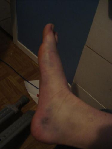 Alors voila je ne peux plus faire de sport pendant 3 semaines 1...