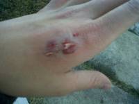 Je me suis fait mordre cette semaine par ma jument! Mais c'était de ma faute, j'ai passé devant son box avec le foin et elle a voulut prendre une...